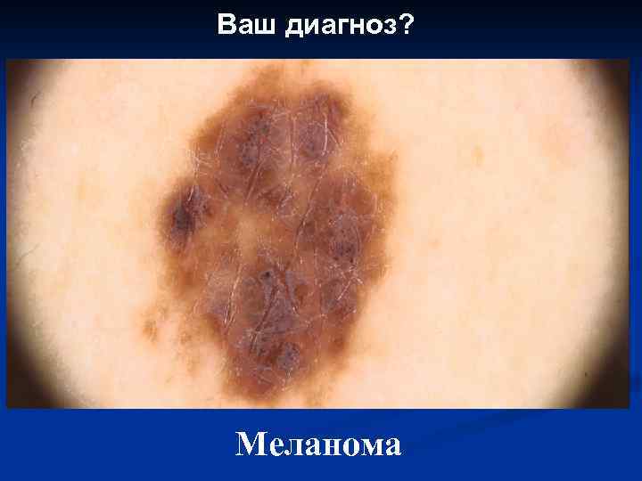 Ваш диагноз? Меланома 