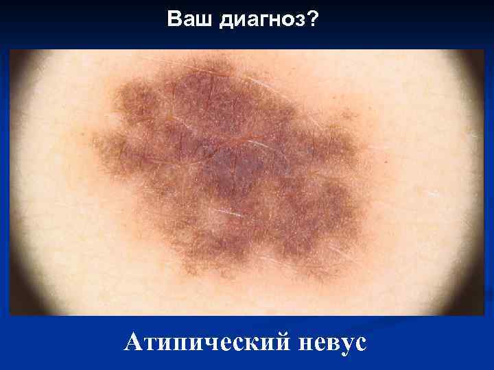 Ваш диагноз? Атипический невус 
