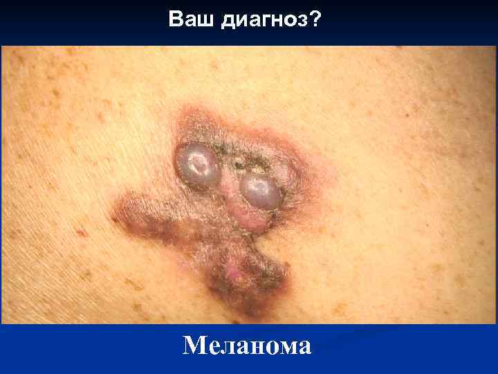 Ваш диагноз? Меланома 
