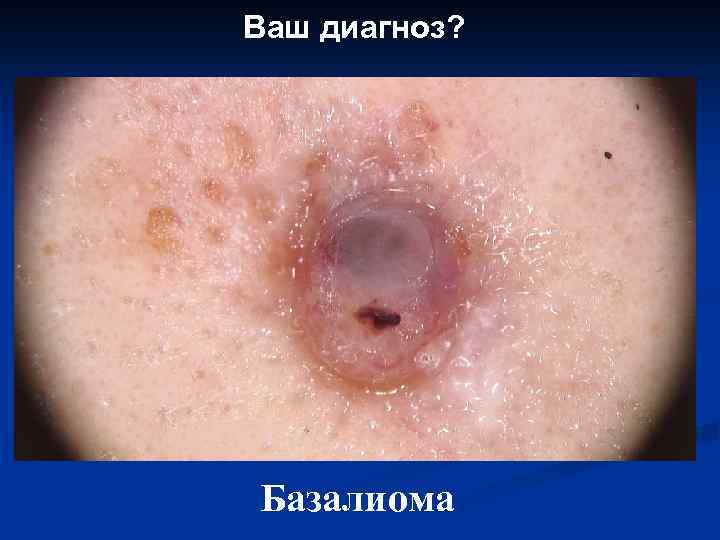 Ваш диагноз? Базалиома 