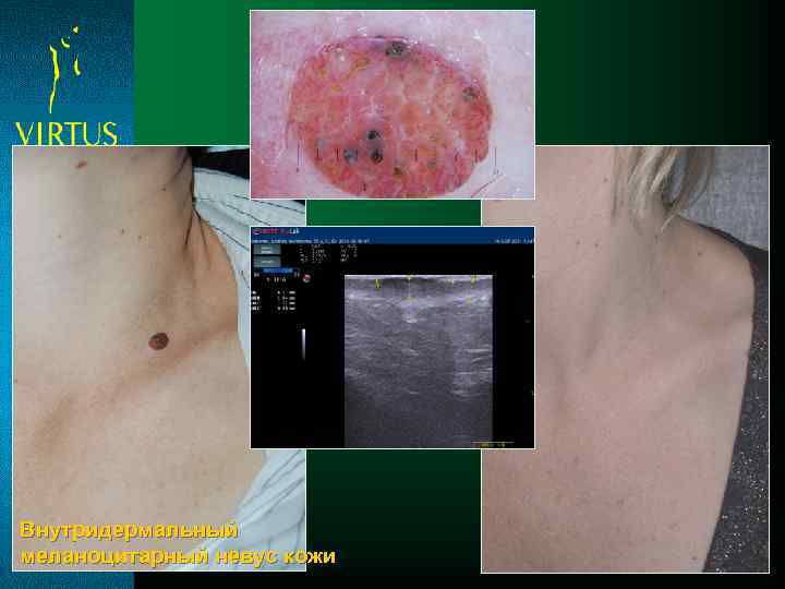 Внутридермальный меланоцитарный невус кожи 