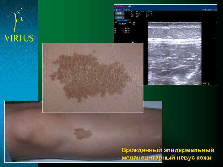 Врожденный эпидермальный меланоцитарный невус кожи 