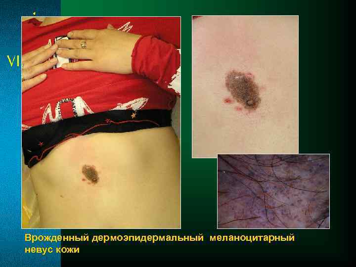 Врожденный дермоэпидермальный меланоцитарный невус кожи 