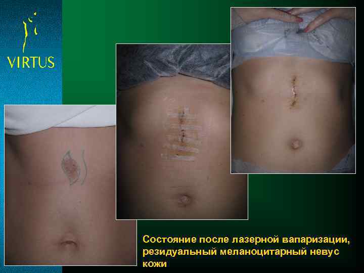 Состояние после лазерной вапаризации, резидуальный меланоцитарный невус кожи 