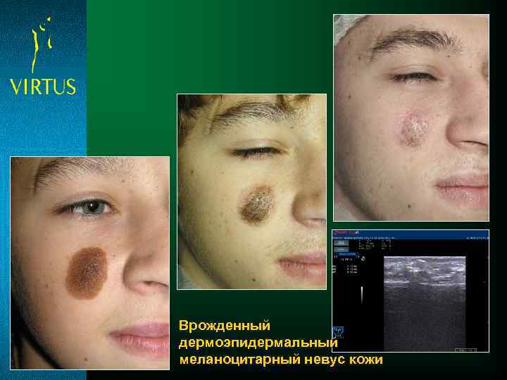 Врожденный дермоэпидермальный меланоцитарный невус кожи 