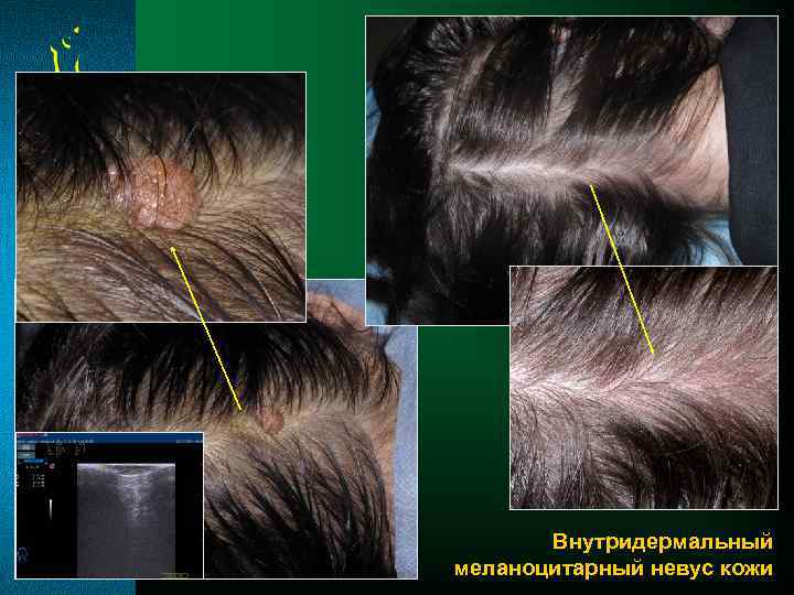 Внутридермальный меланоцитарный невус кожи 