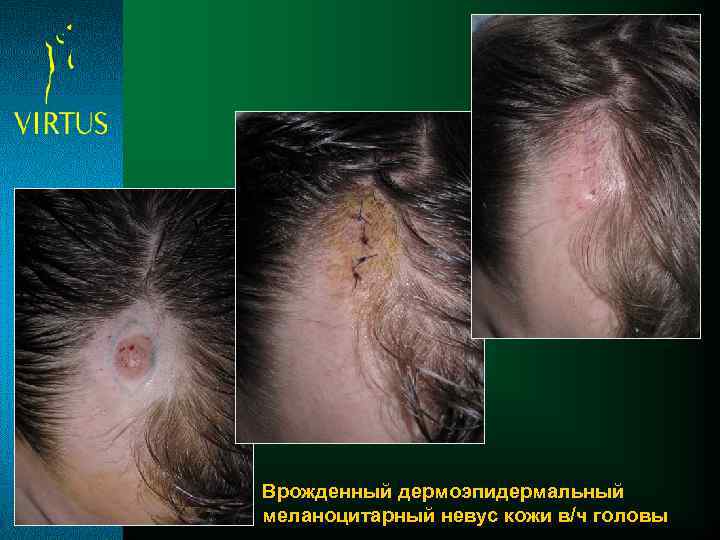 Врожденный дермоэпидермальный меланоцитарный невус кожи в/ч головы 