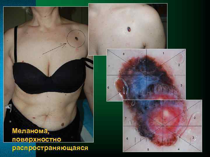 Меланома, поверхностно распространяющаяся 