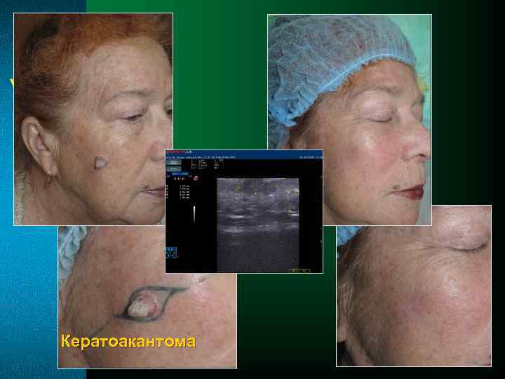 Кератоакантома 