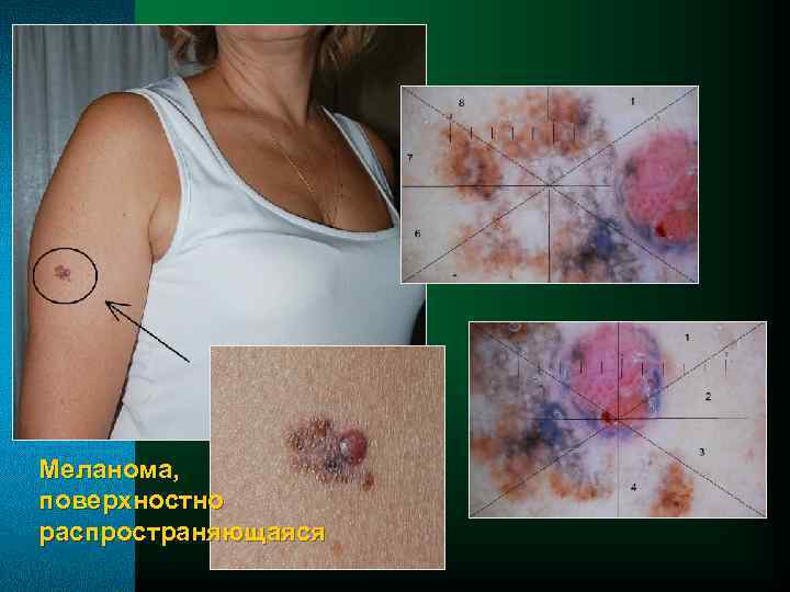 Меланома, поверхностно распространяющаяся 
