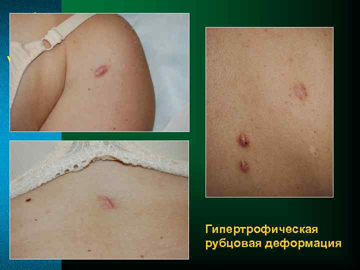 Гипертрофическая рубцовая деформация 