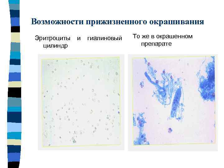 Возможности прижизненного окрашивания Эритроциты цилиндр и гиалиновый То же в окрашенном препарате 