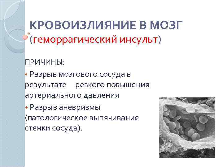 КРОВОИЗЛИЯНИЕ В МОЗГ (геморрагический инсульт) ПРИЧИНЫ: • Разрыв мозгового сосуда в результате резкого повышения