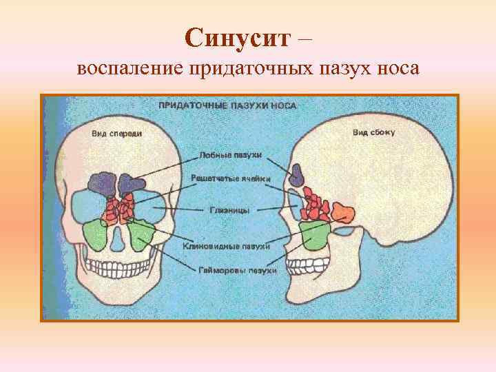 Синусит – воспаление придаточных пазух носа 