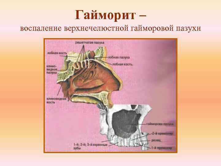 Гайморит – воспаление верхнечелюстной гайморовой пазухи 