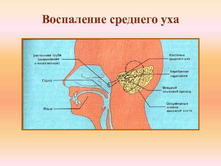 Воспаление среднего уха 