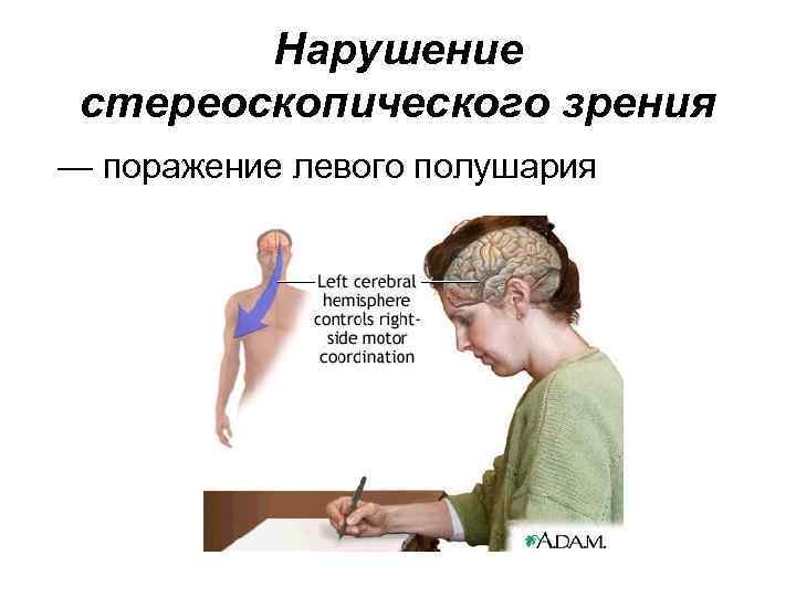 Нарушение стереоскопического зрения — поражение левого полушария 