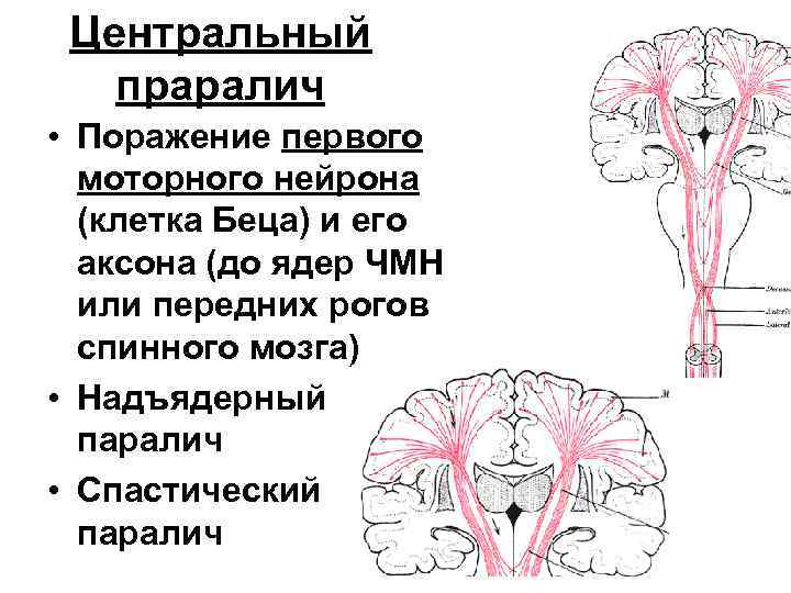 Центральный праралич • Поражение первого моторного нейрона (клетка Беца) и его аксона (до ядер