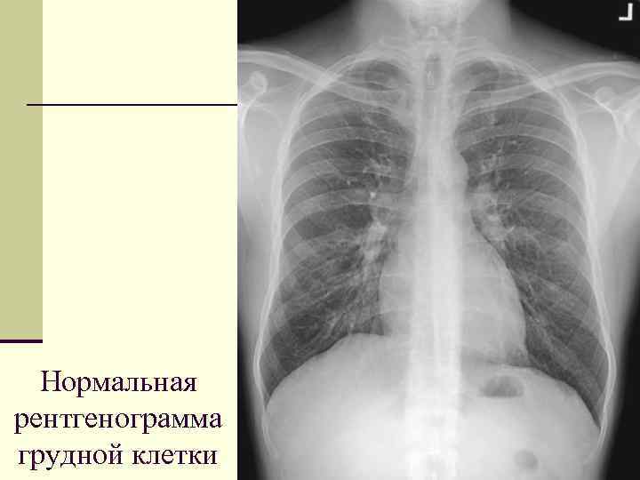 На компьютерной томограмме органов грудной клетки трахея определяется как