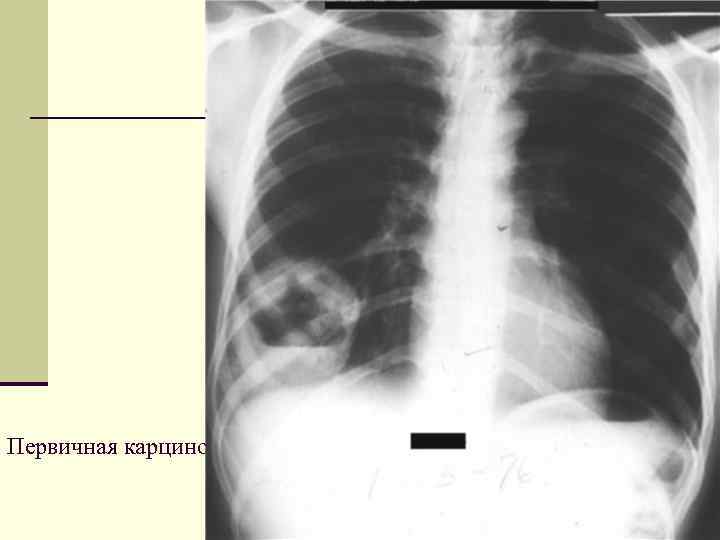 Первичная карцинома 