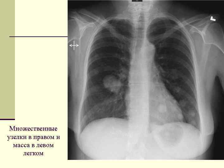 Множественные узелки в правом и масса в левом легком 