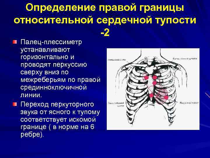 Границы сердечной тупости