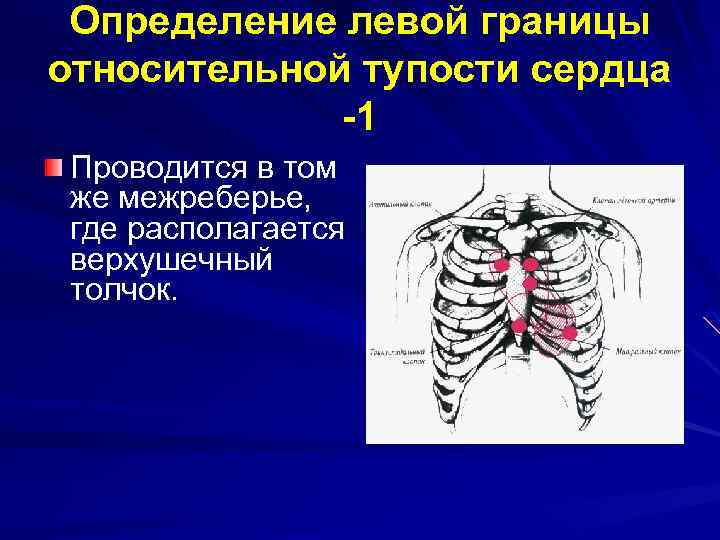 Определение левой границы относительной тупости сердца -1 Проводится в том же межреберье, где располагается