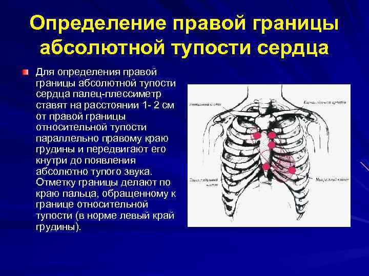 Перкуссия абсолютной тупости сердца