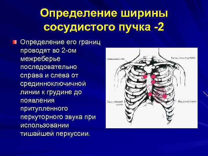 Ширина пучка. Перкуссия сосудистого пучка сердца. Границы сосудистого пучка. Границы сосудистого пучка сердца. Ширина сосудистого пучка.