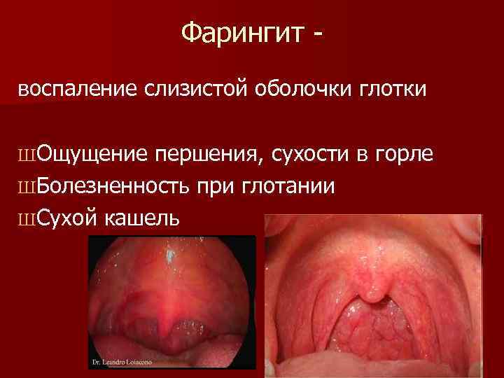 Фарингит воспаление слизистой оболочки глотки ШОщущение першения, сухости в горле ШБолезненность при глотании ШСухой