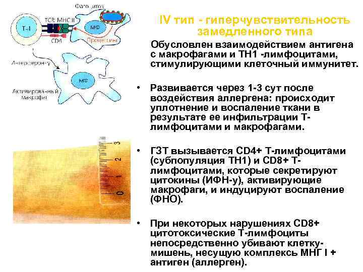 IV тип - гиперчувствительность замедленного типа Обусловлен взаимодействием антигена с макрофагами и ТН 1