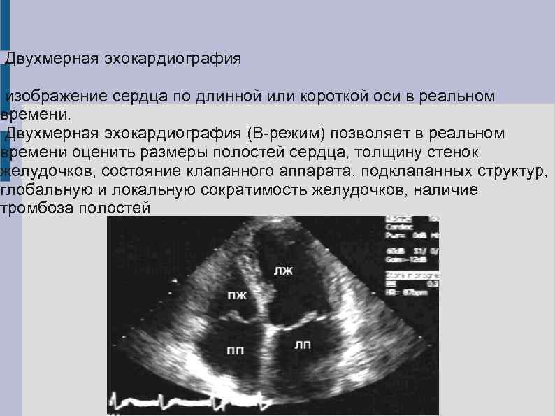  Двухмерная эхокардиография изображение сердца по длинной или короткой оси в реальном времени. Двухмерная