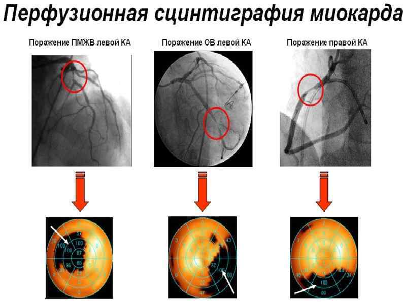 Презентация сцинтиграфия миокарда