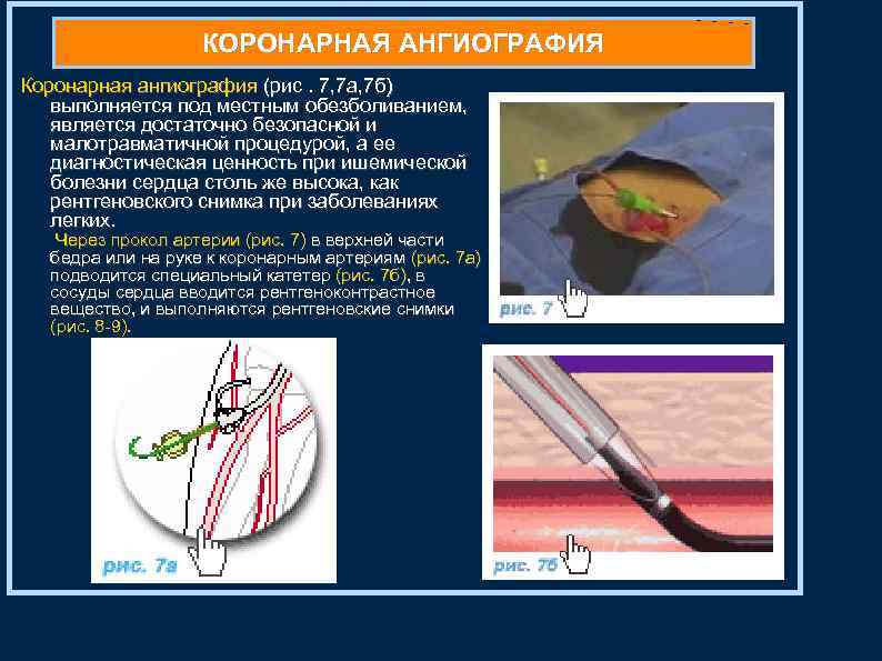 КОРОНАРНАЯ АНГИОГРАФИЯ Коронарная ангиография (рис. 7, 7 а, 7 б) выполняется под местным обезболиванием,