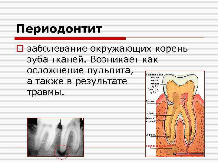 Периодонтит o заболевание окружающих корень зуба тканей. Возникает как осложнение пульпита, а также в