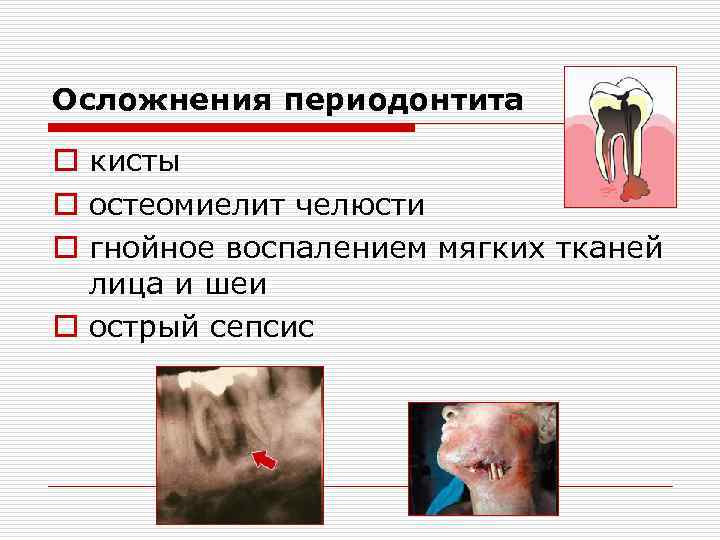 Осложнения периодонтита o кисты o остеомиелит челюсти o гнойное воспалением мягких тканей лица и