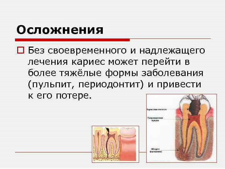 Осложнения o Без своевременного и надлежащего лечения кариес может перейти в более тяжёлые формы