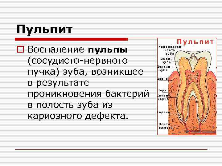 Пульпит o Воспаление пульпы (сосудисто-нервного пучка) зуба, возникшее в результате проникновения бактерий в полость