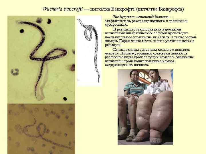 Wucheria bancrofti — нитчатка Банкрофта (нитчатка Банкрофта) Возбудитель «слоновей болезни» элефантиазиса, распространенного в тропиках