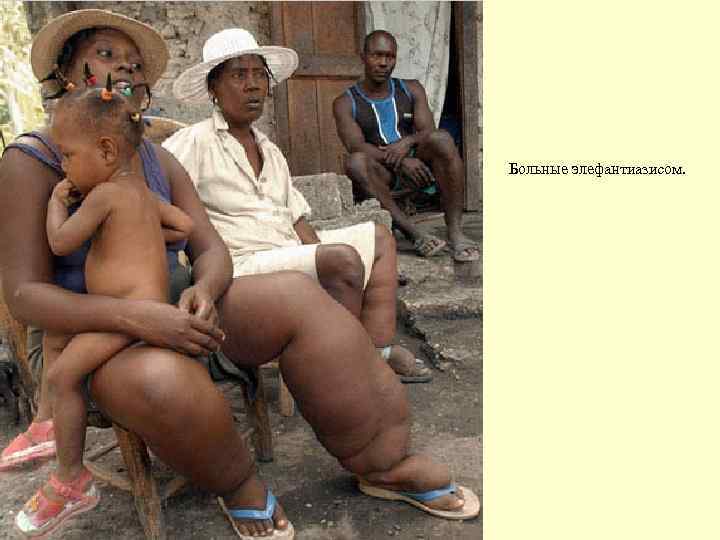 Больные элефантиазисом. Wuchereria bancrofti 