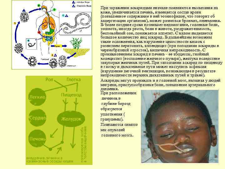При заражении аскаридами вначале появляются высыпания на коже, увеличивается печень, изменяется состав крови (повышенное
