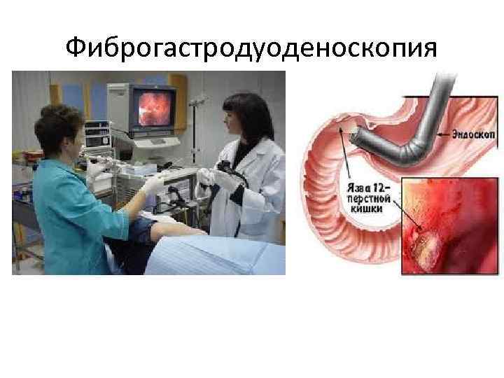 Фиброгастродуоденоскопия 