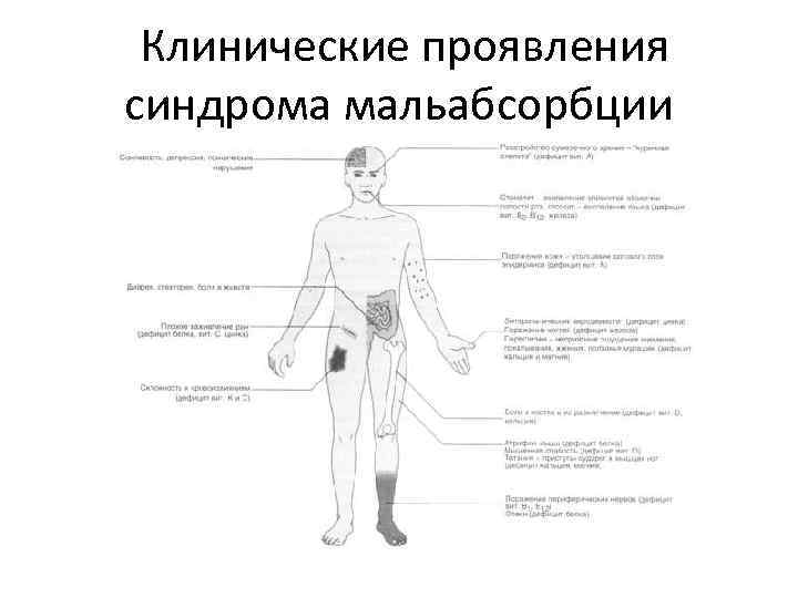  Клинические проявления синдрома мальабсорбции 