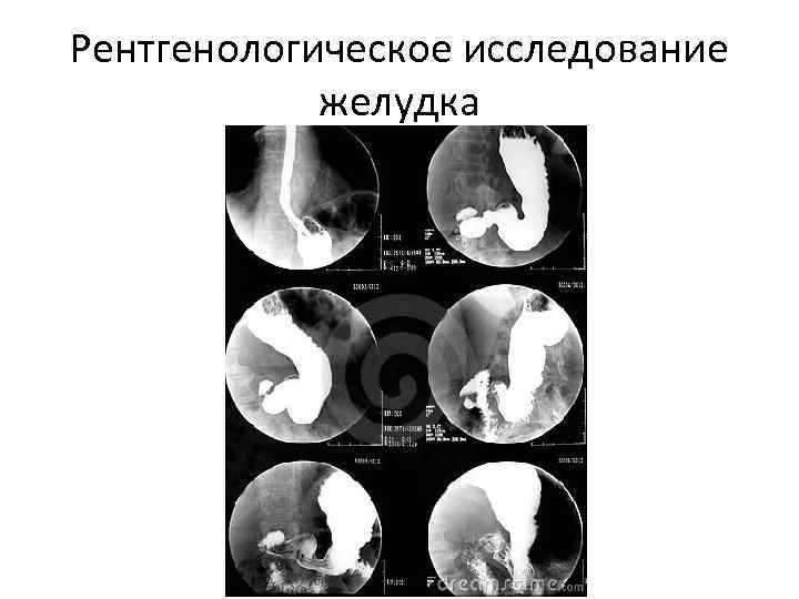 Рентгенологическое исследование желудка 