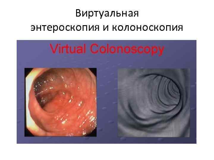 Виртуальная энтероскопия и колоноскопия 