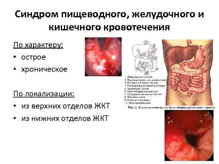 Синдром пищеводного, желудочного и кишечного кровотечения По характеру: • острое • хроническое По локализации: