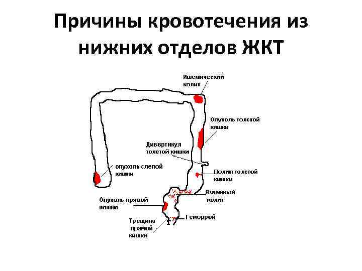 Причины кровотечения из нижних отделов ЖКТ 