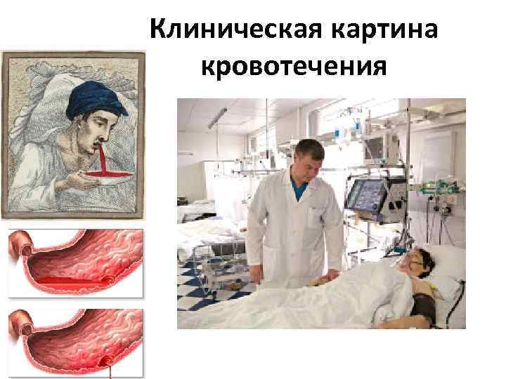 Клиническая картина кровотечения 