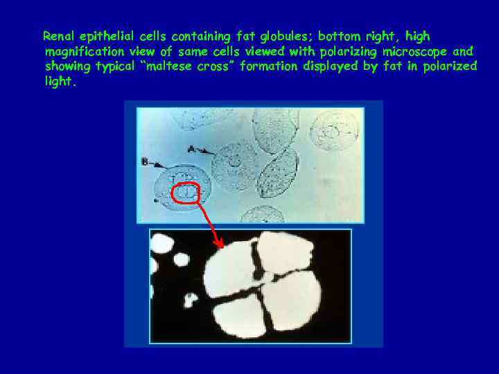 Renal epithelial cells containing fat globules; bottom right, high magnification view of same cells