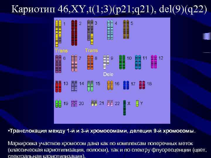 Кариотип 46, XY, t(1; 3)(p 21; q 21), del(9)(q 22) • Транслокация между 1